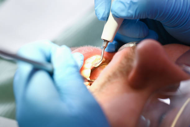 Emergency Dental Filling Replacement in KY